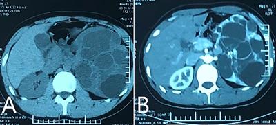 Giant Polycystic Papillary Renal Cell Carcinoma: A Case Report and Literature Review